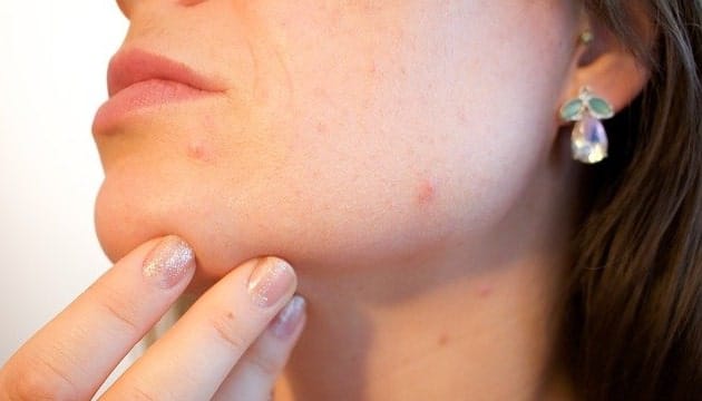 Homemade Remedies to Remove Blackheads in Hindi