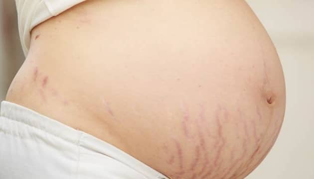 how to remove stretch marks in hindi